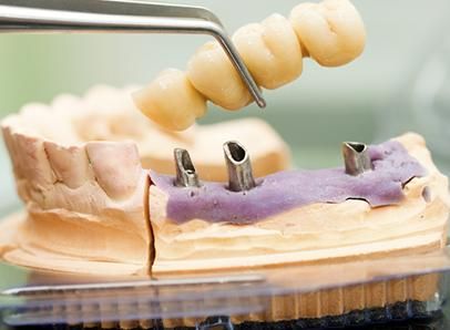 Laboratorio Dental Macías y Calvete implante dental